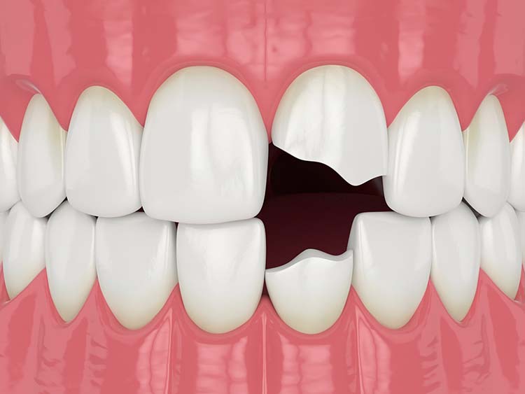 broken teeth monmouth freehold new jersey broken teeth monmouth freehold new jersey