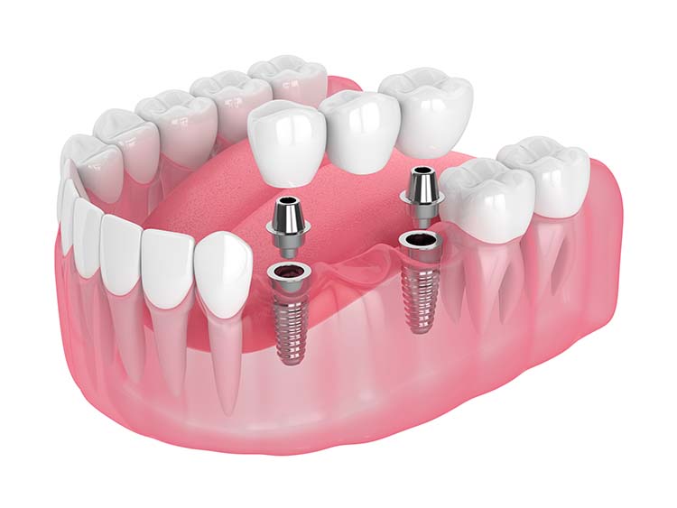 dental bridges